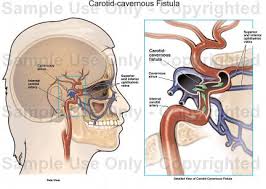 Ảnh 4 của Carotid–Cavernous Fistula